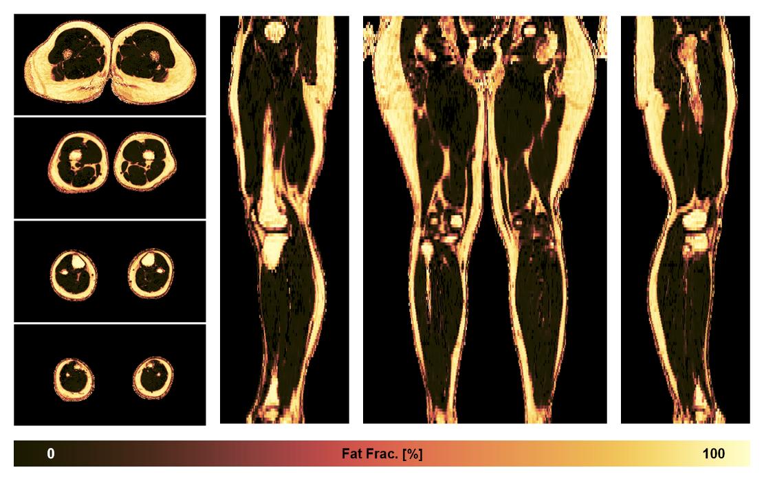 The fat fraction of the lower extremity obtained from the dixon reconstruction for muscle water fat quantification.